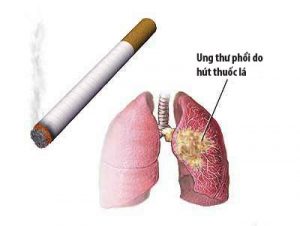 Hút thuốc lá là nguyên nhân gây ung thư phổi