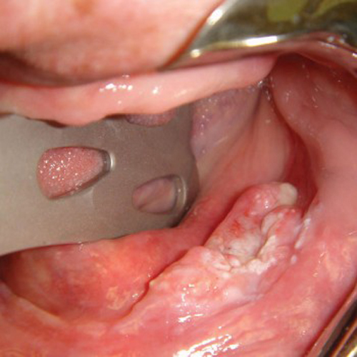 Tầm soát ung thư miệng là gì?