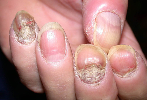 Móng tay bị nhiễm khuẩn do thói quen cắn móng tay