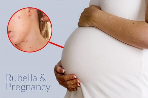 Nhiễm bệnh rubella trong thai kỳ có nguy hiểm hay không?