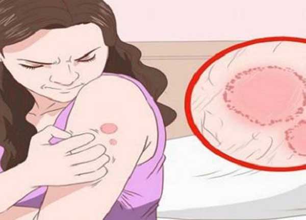 Bạn có những bệnh nấm da thường gặp nào không ?