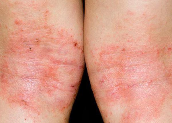 Tìm hiểu nguyên nhân và cách điều trị bệnh eczema