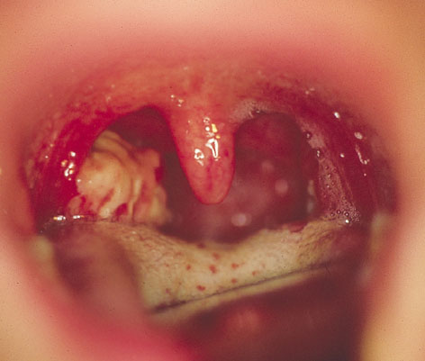 acute tonsillitis (strep, EBV)