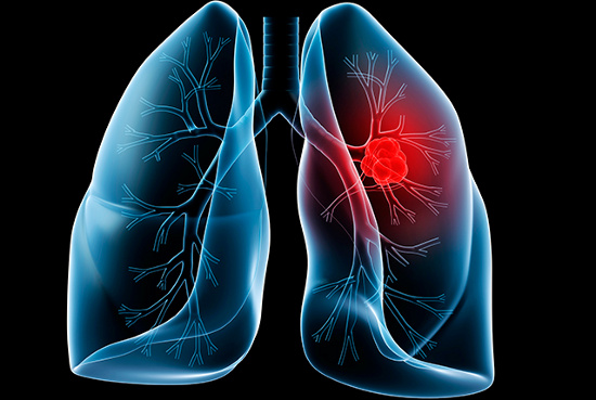 Ung thư phổi là căn bệnh có tỷ lệ tử vong hàng đầu
