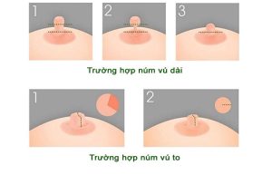 Thu nhỏ nhũ hoa bằng phẫu thuật là hiệu quả nhất