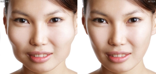 Phẫu thuật gò má cao giúp bạn có khuôn mặt hài hòa hơn