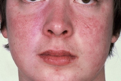 Triệu chứng và nguyên nhân gây ra bệnh Lupus