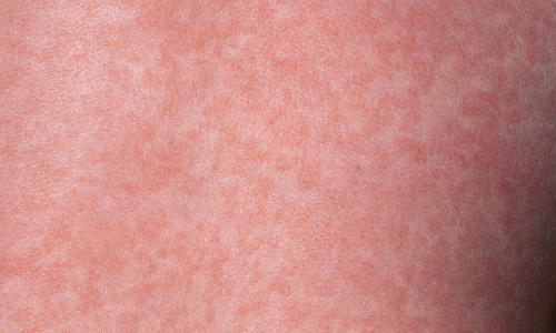 Nổi ban sau khi hạ sốt là  triệu chứng điển hình của sốt phát ban