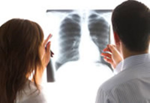 Những đặc điểm nổi bật của bệnh ung thư phổi