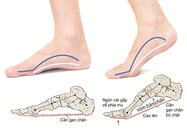Nguyên nhân bệnh đau gót chân – viêm cân gan chân
