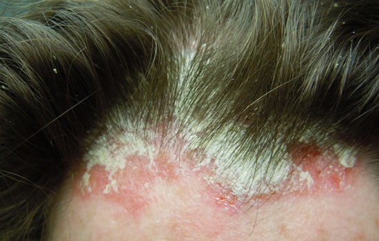 Nấm da đầu nếu không chữa khỏi sẽ gây nguy hiểm