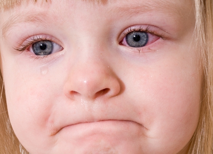 Bệnh đau mắt đỏ trẻ nhỏ căn bệnh không thể xem thường