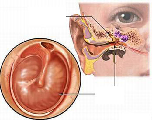 Thủng màng nhĩ do viêm tai giữa