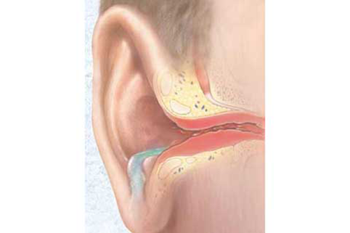 Sau khi mắc bệnh viêm tai giữa biến chứng để lại có nguy hiểm không?