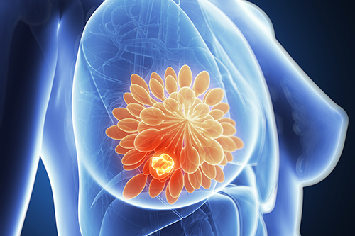 Chuyên gia Dược cho biết những dấu hiệu thường gặp của ung thư vú