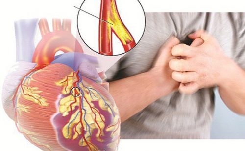 Tìm hiểu nguyên nhân gây ra động mạch vành