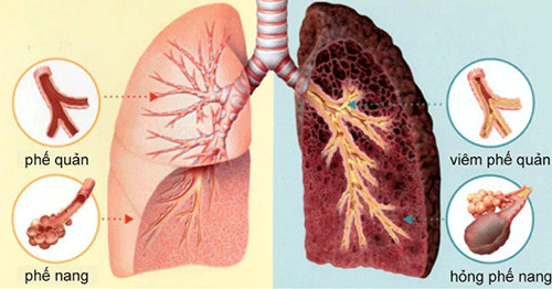 Sự khác nhau giữa phổi người bình thường và người bị ung thư phổi