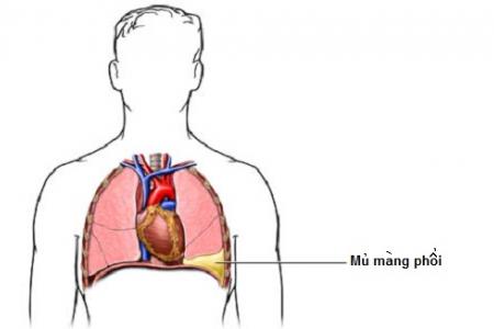 Cách điều trị bệnh viêm mủ màng phổi