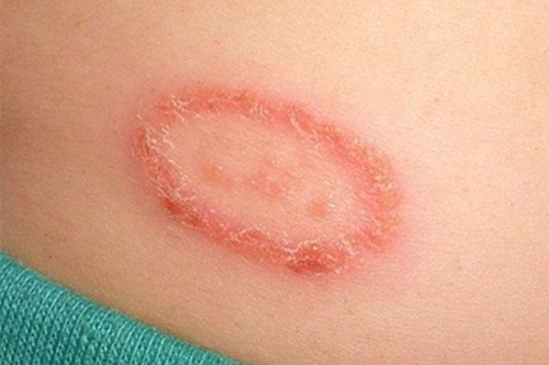 Cùng chuyên gia Điều dưỡng tìm hiểu những yếu tố gây nên bệnh Eczema
