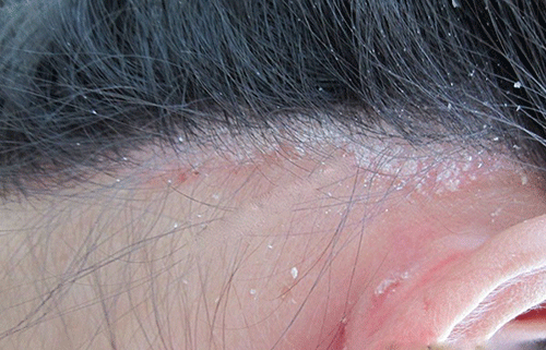 Bệnh nấm da đầu: Triệu chứng, nguyên nhân và giải pháp điều trị