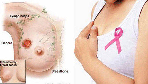 Những điểm phân biệt ung thư vú và u vú lành tính theo góc nhìn chuyên gia