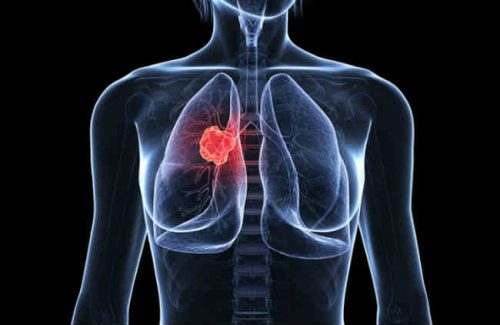 Những điều cần biết về ung thư phổi biểu mô tuyến