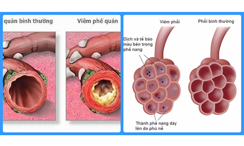 Nhận biết sự khác nhau giữa viêm phế quản và viêm phổi như thế nào?
