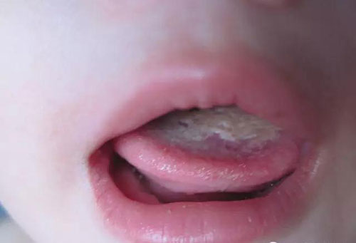 Có rất nhiều nguyên nhân gây ra bệnh nấm miệng