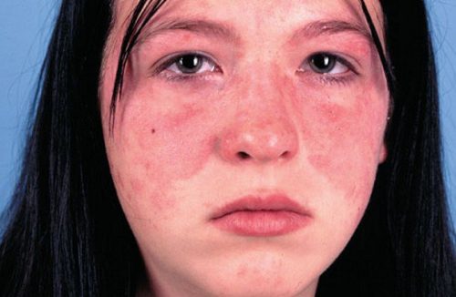 Những dấu hiệu nhận biết bệnh Lupus ban đỏ