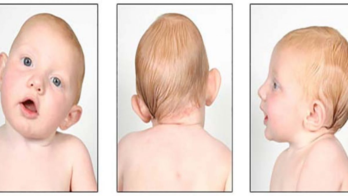 Thuốc điều trị vẹo cổ theo phương pháp Đông y