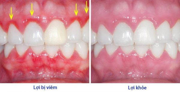 Biểu hiện của viêm chân răng 