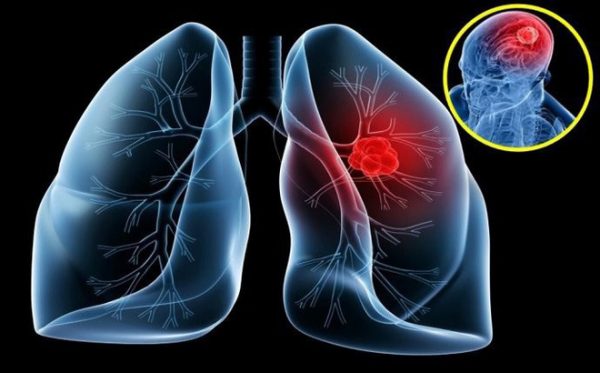 Bác sĩ Dược Sài Gòn nói về biểu hiện thường gặp ở bệnh ung thư phổi