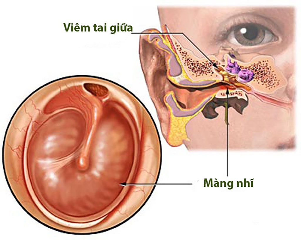Những biến chứng nguy hiểm của căn bệnh viêm tai giữa