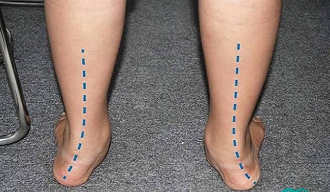 Hội chứng bàn chân bẹt có nguy hiểm không?