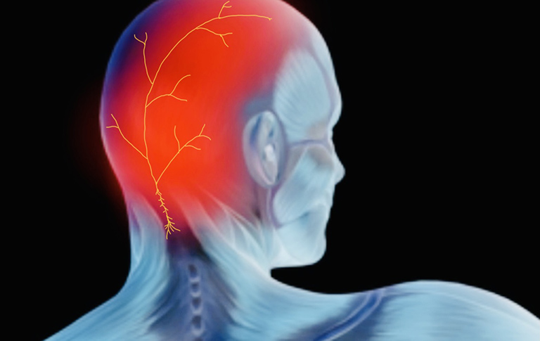 Những điều cần biết về đau dây thần kinh chẩm