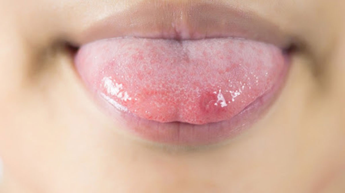 Phân biệt giữa nhiệt miệng và ung thư lưỡi