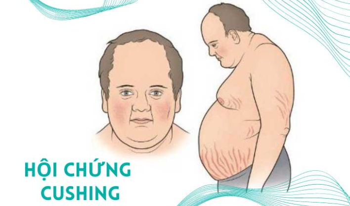 Nguyên nhân và triệu chứng của hội chứng Cushing là gì?