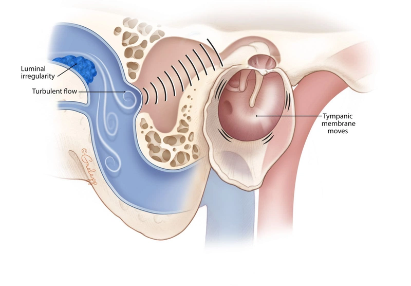 Nguyên nhân nào gây ra bệnh lý ù tai mạch đập?