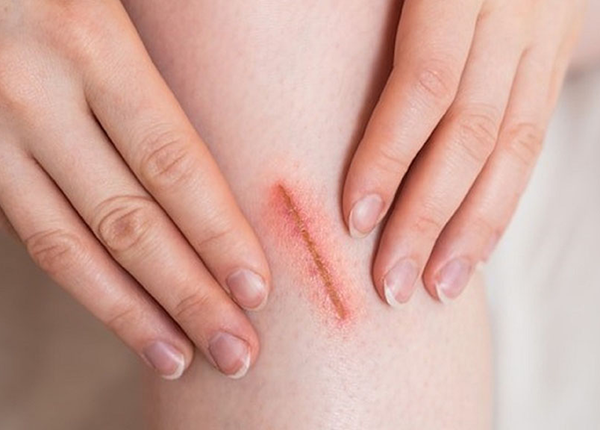 Nhận biết sớm các dấu hiệu tiểu đường trên da để điều trị kịp thời